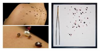 Exhibitions - 40under40 Lauren Kalman, born Cleveland, OH 1980, Blooms, Efflorescence, and Other Dermatological Embellishments (Cystic Acne, Back), 2009, ink jet print, 26 x 26 in, acupuncture needles, gold-plated silver, semiprecious stones, tweezers, le